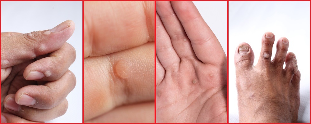 types-of-warts