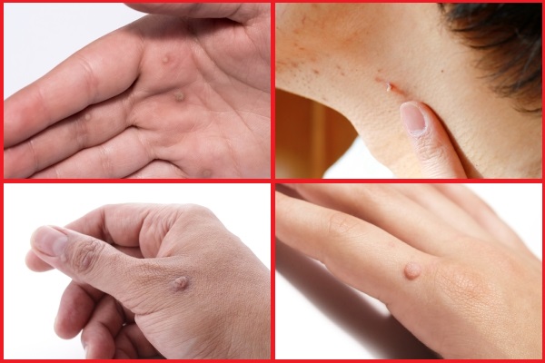 warts types