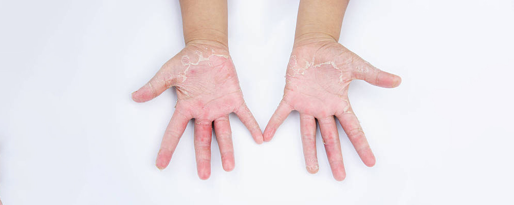 Erythrodermic Psoriasis 1