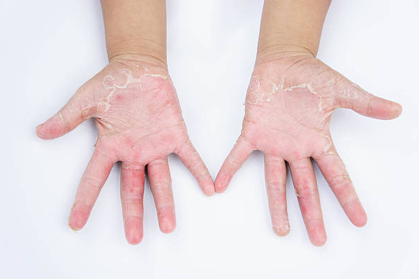 Erythrodermic Psoriasis