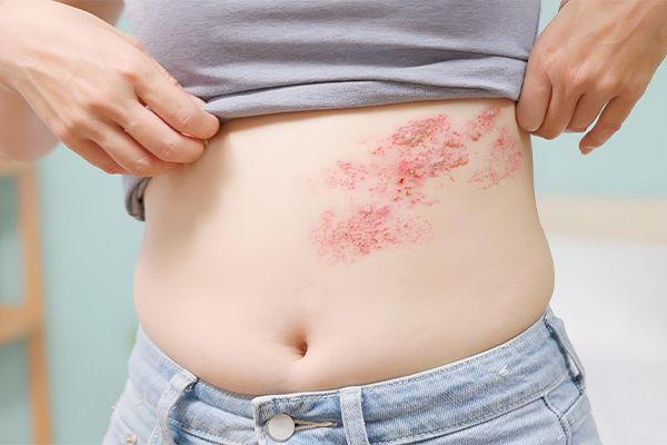Genital Psoriasis
