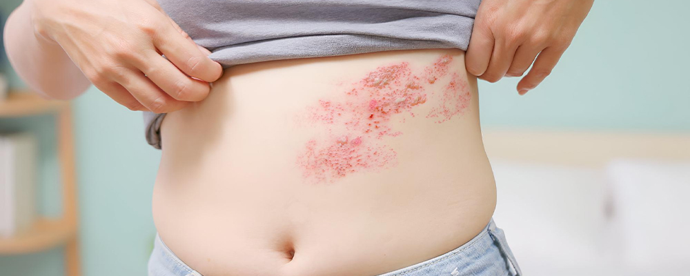 genitals-psoriasis-
