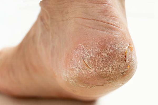 Psoriasis on Feet