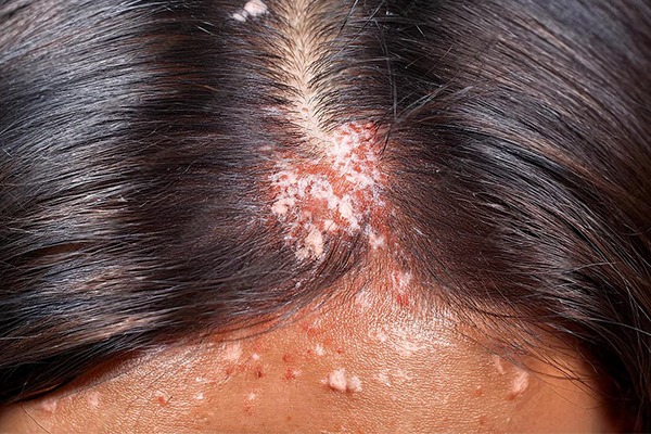 Scalp Eczema Vs Psoriasis