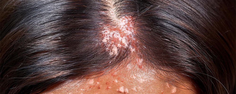 Scalp Eczema Vs Scalp Psoriasis