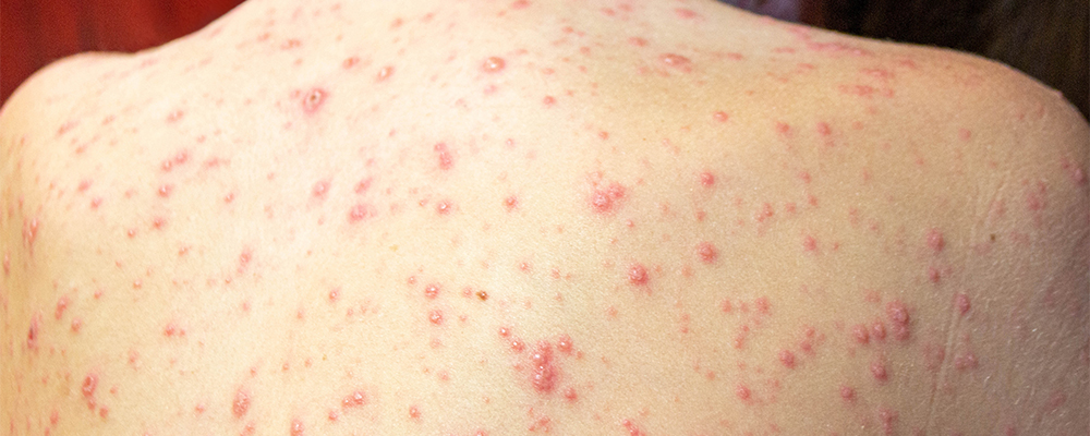cutaneous-lupus-erythematosus-1