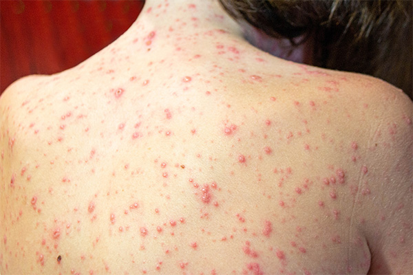 cutaneous-lupus-erythematosus