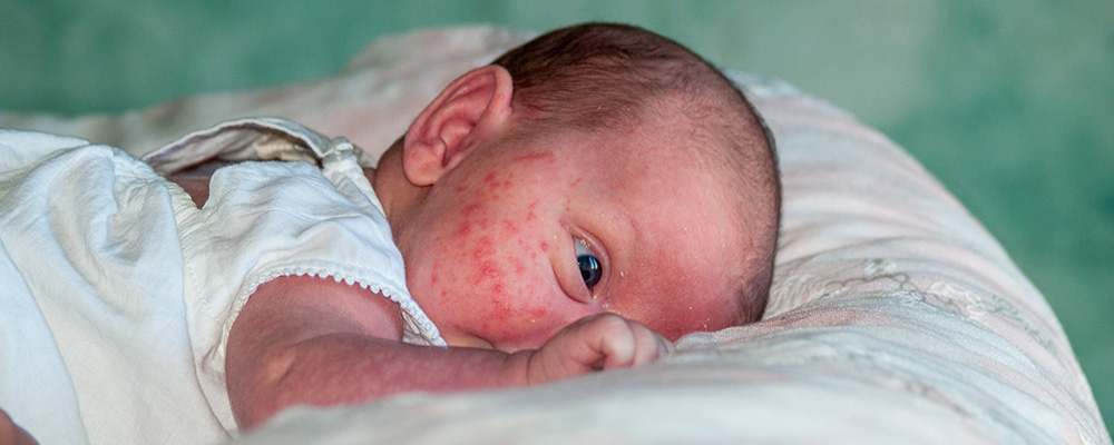 Neonatal Lupus