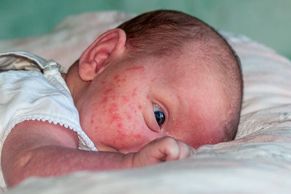 neonatal-lupus