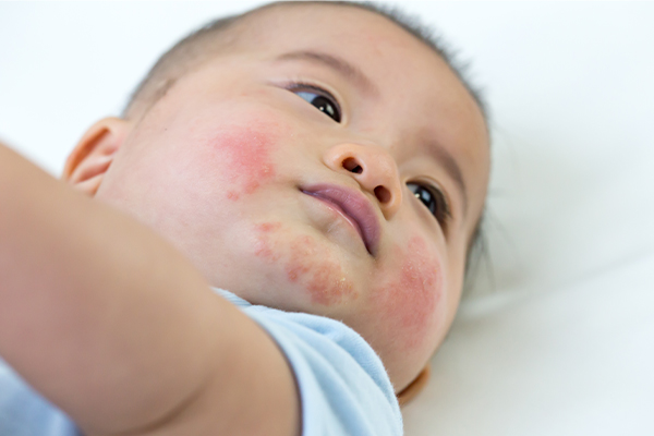 Pediatric Lupus