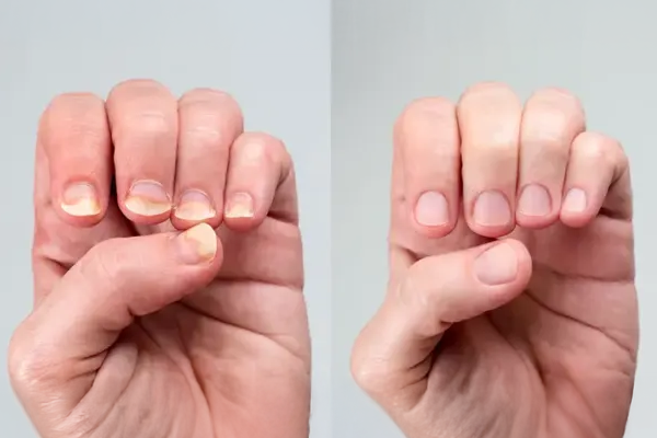 Nail Psoriasis Vs Fungus