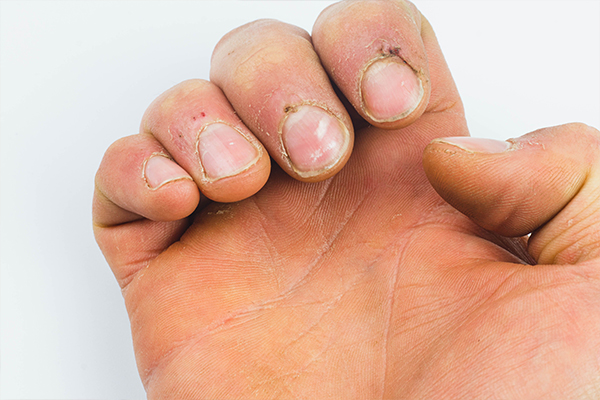 Nail Psoriasis