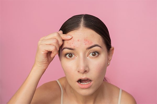 Forehead Acne