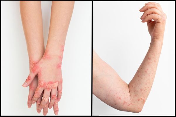 Nummular Eczema vs Ringworm