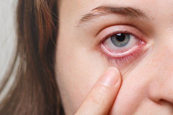 Ocular Rosacea