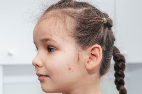 alopecia-areata-in-kids