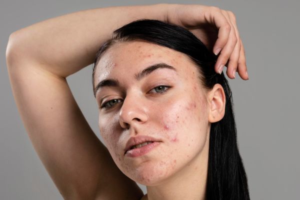 Eczema On Face