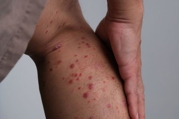 Guttate Psoriasis