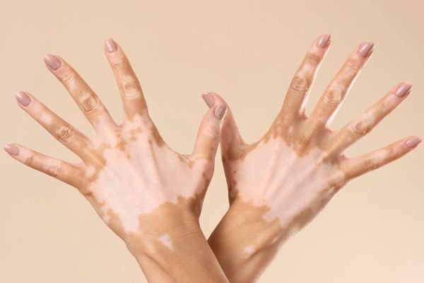penile-vitiligo