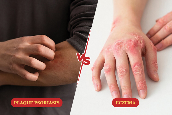 plaque-psoriasis-vs-eczema