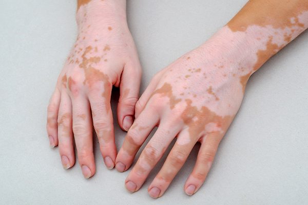 Leucoderma vs Vitiligo