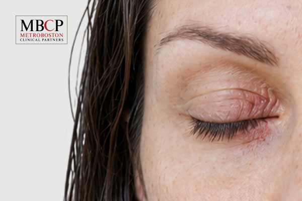 Eczema on Eyelid