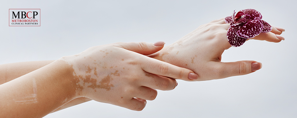 white-spots-on-skin